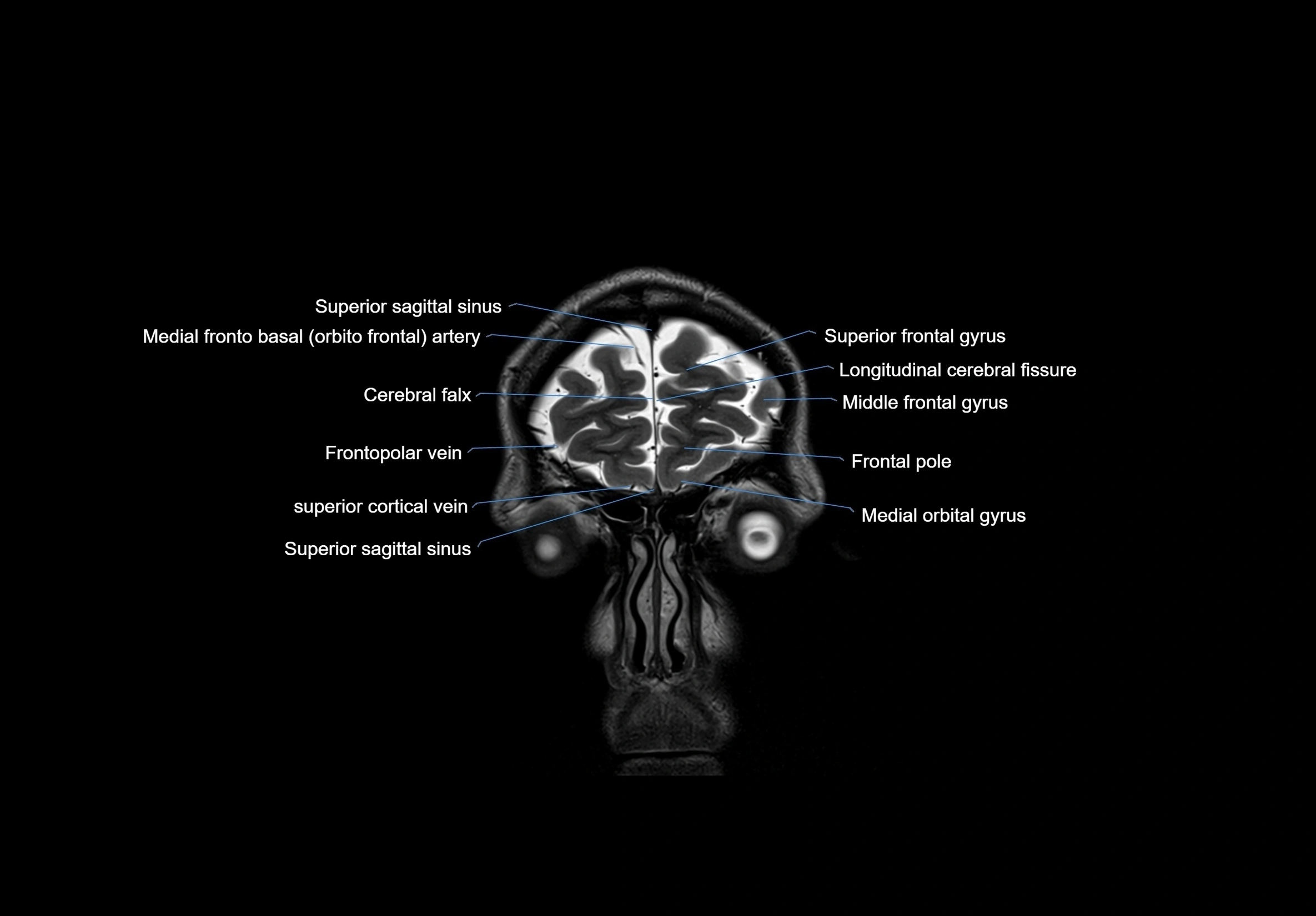 MRI Brain coronal cross sectional labelled anatomy 3T image  -img-00001-00008.webp
